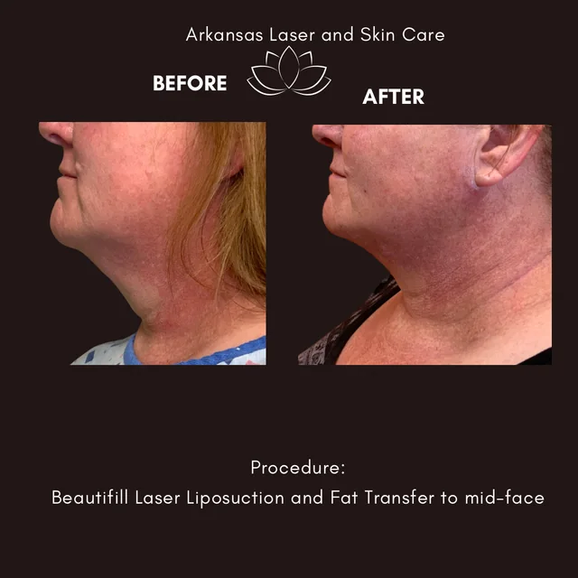 Laser liposuction gallery image