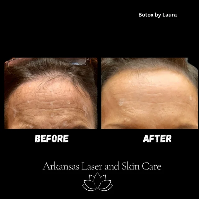 Botox gallery image