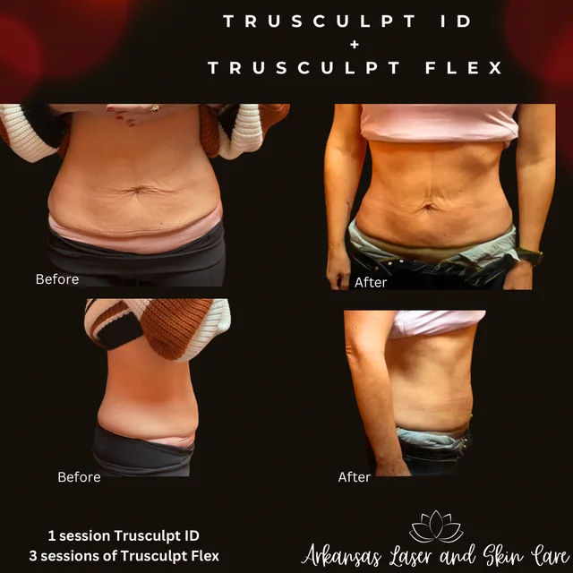 TruSculpt gallery image