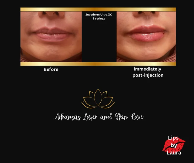 Dermal fillers gallery image