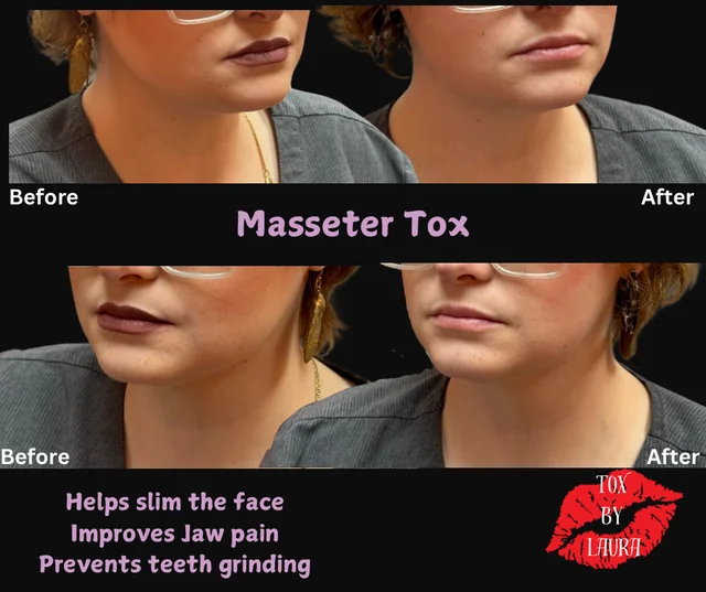 Dermal fillers gallery image