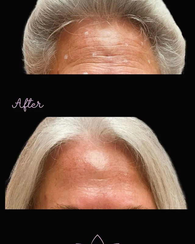 Botox gallery image