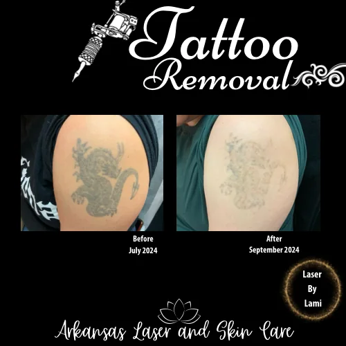 Tattoo removal gallery image