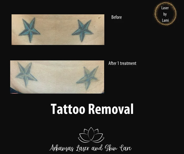 Tattoo removal gallery image