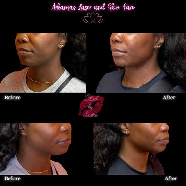 Dermal fillers gallery image