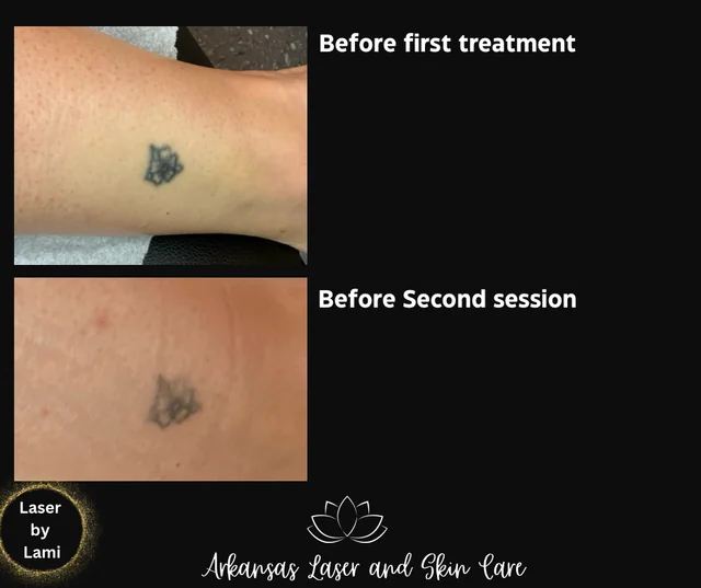 Tattoo removal gallery image