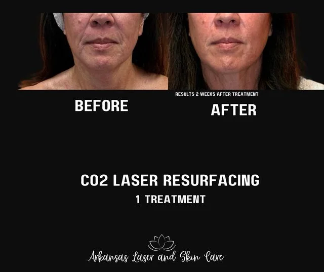 CO2 laser resurfacing gallery image