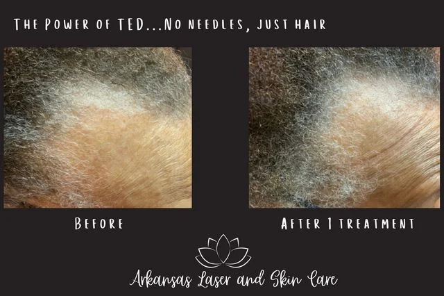 Hair restoration gallery image