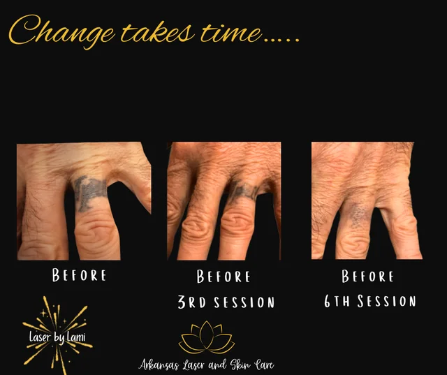 Tattoo removal gallery image