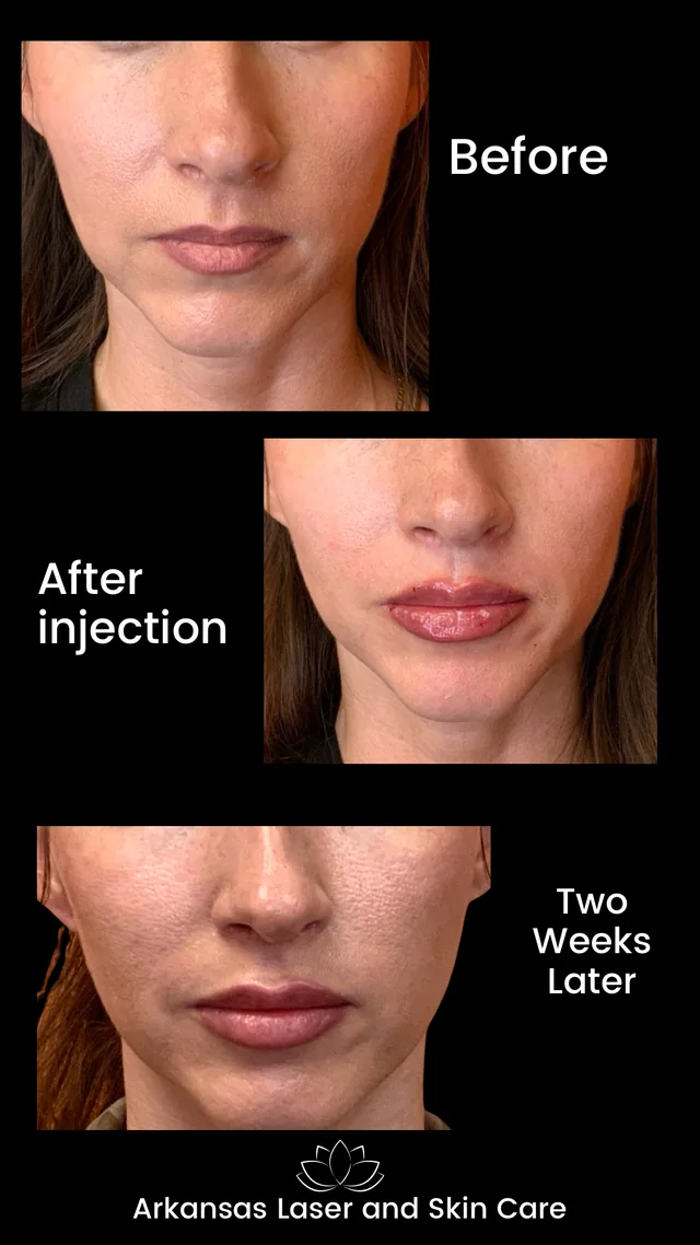 Dermal fillers gallery image