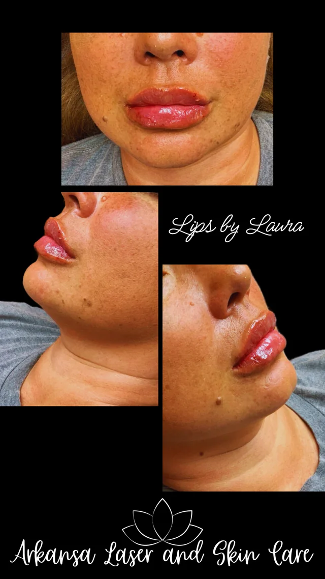 Dermal fillers gallery image