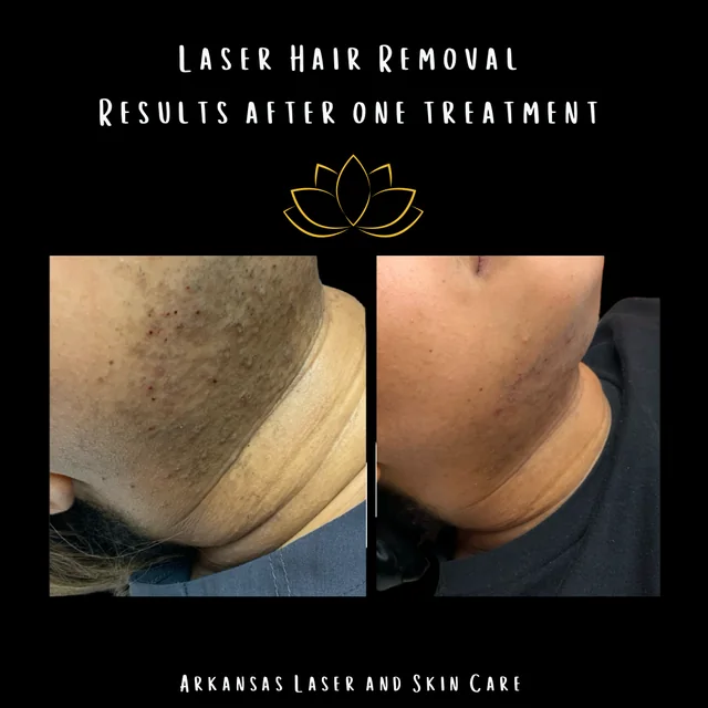 Laser hair removal gallery image