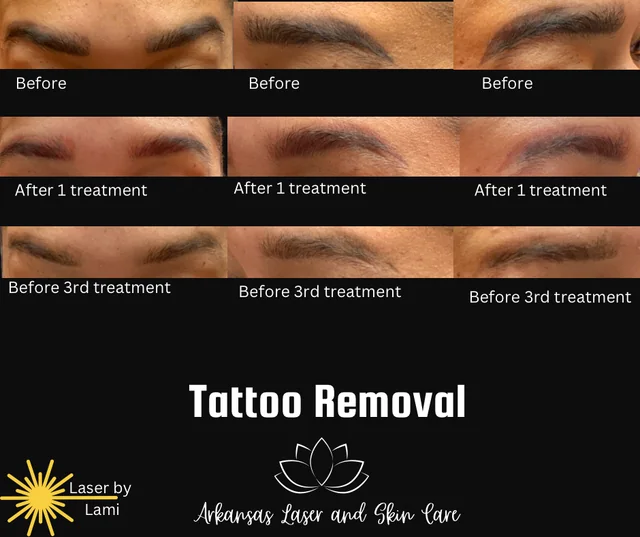 Tattoo removal gallery image